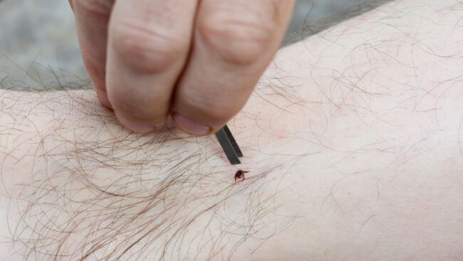 How To Remove Ticks From Your Skin