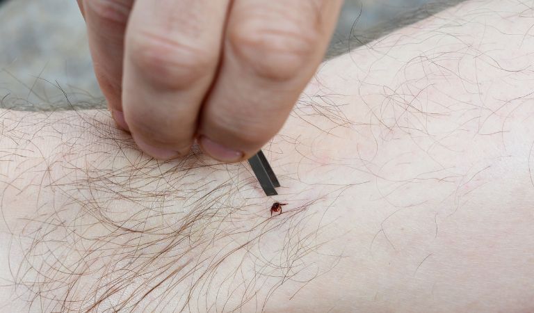 How To Remove Ticks From Your Skin